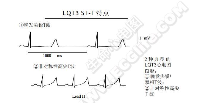 典型的LQT3心电图图形