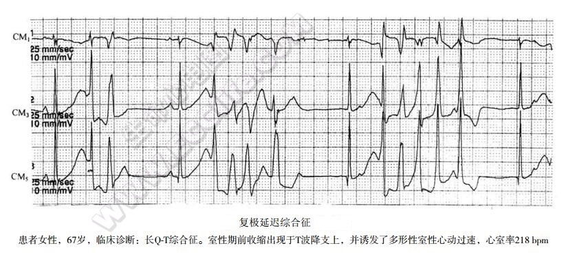 复极延迟综合征心电图