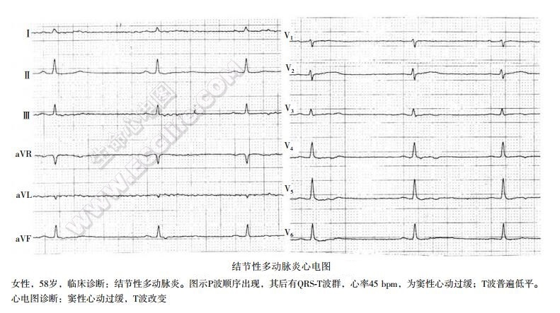 结节性多动脉炎心电图