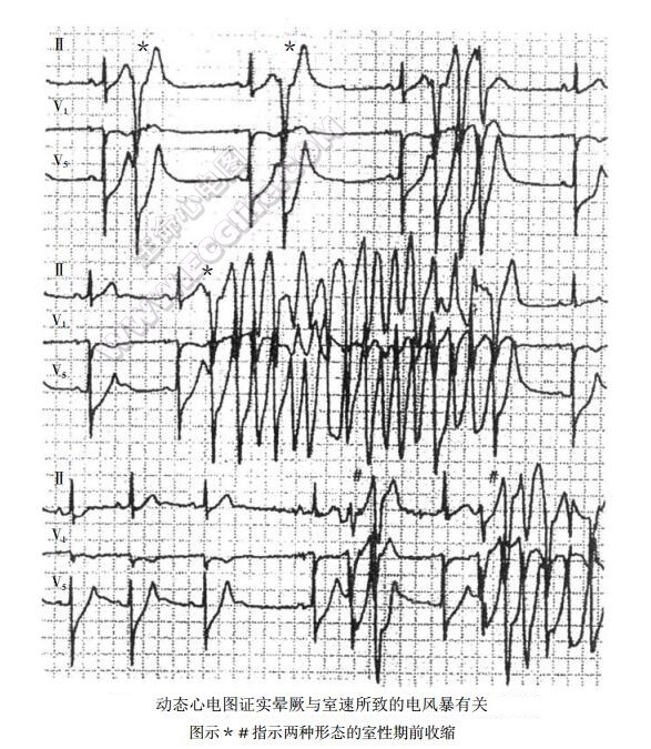 动态心电图证实晕噘与室速所致的电风暴有关