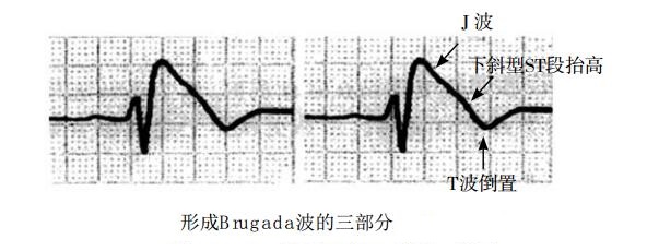 形成Brugada波的三部分