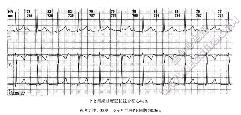 PR间期过度延长综合征心电图表现