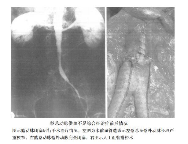 骼总动脉供血不足综合征治疗前后情况