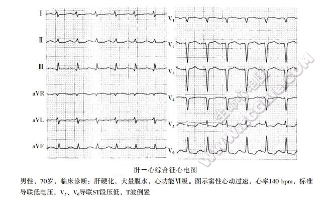 肝心综合征心电图表现