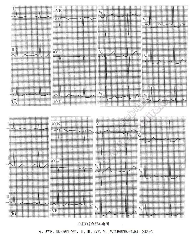 心脏X综合征患者心电图表现
