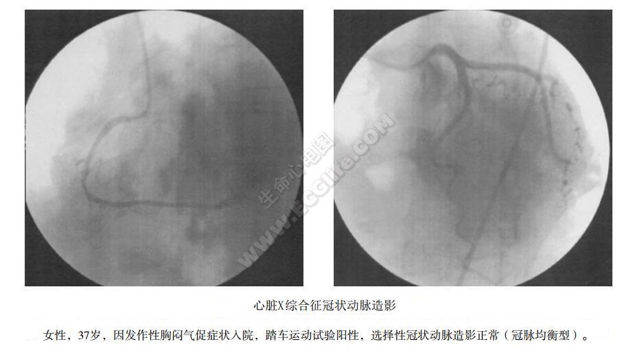 心脏X综合征冠状动脉造影