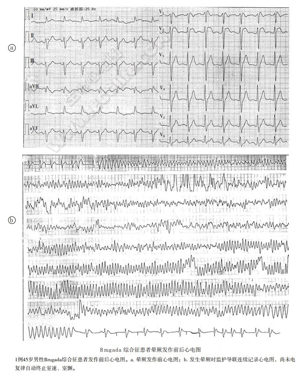 Brugada综合征患者晕厥发作前后心电图