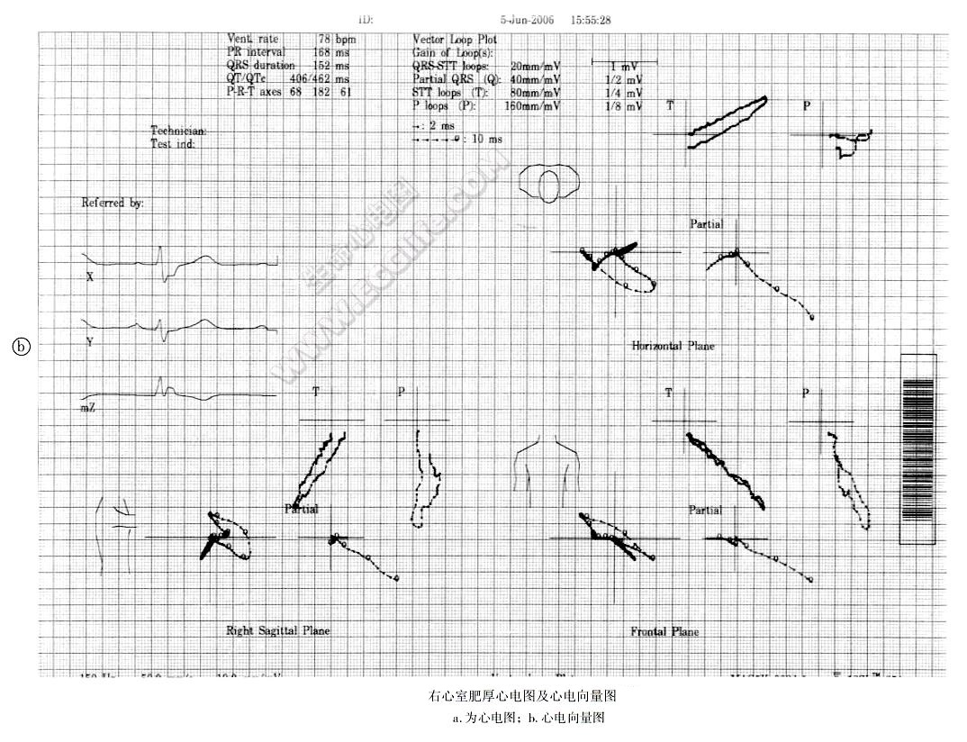 右心室肥厚诊断心电向量图