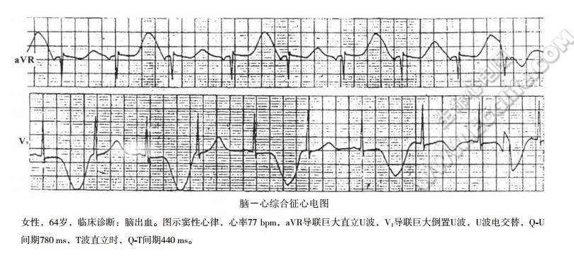 脑心综合征