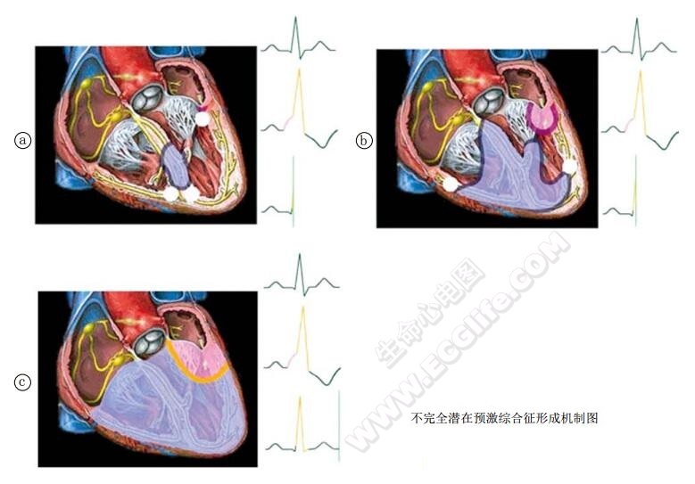 不完全潜在预激综合征形成机制图