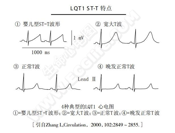 LQT1的典型心电图图形