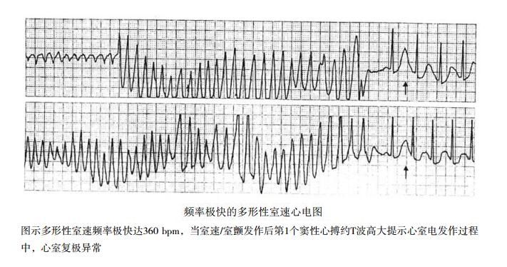 频率极快的多形性室速心电图