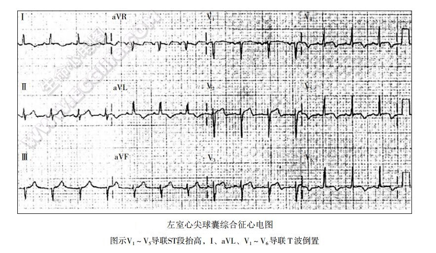 左室心尖球囊综合征（应激性心肌病）心电图表现