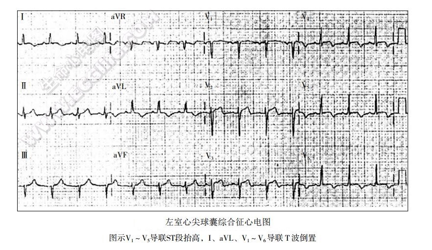 左室心尖球囊综合征（应激性心肌病）