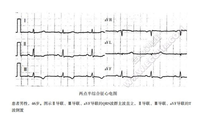 两点半综合征心电图表现