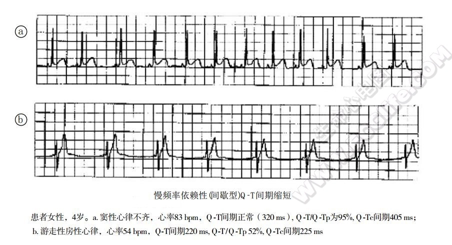 慢频率依赖性（间歇型）QT间期缩短