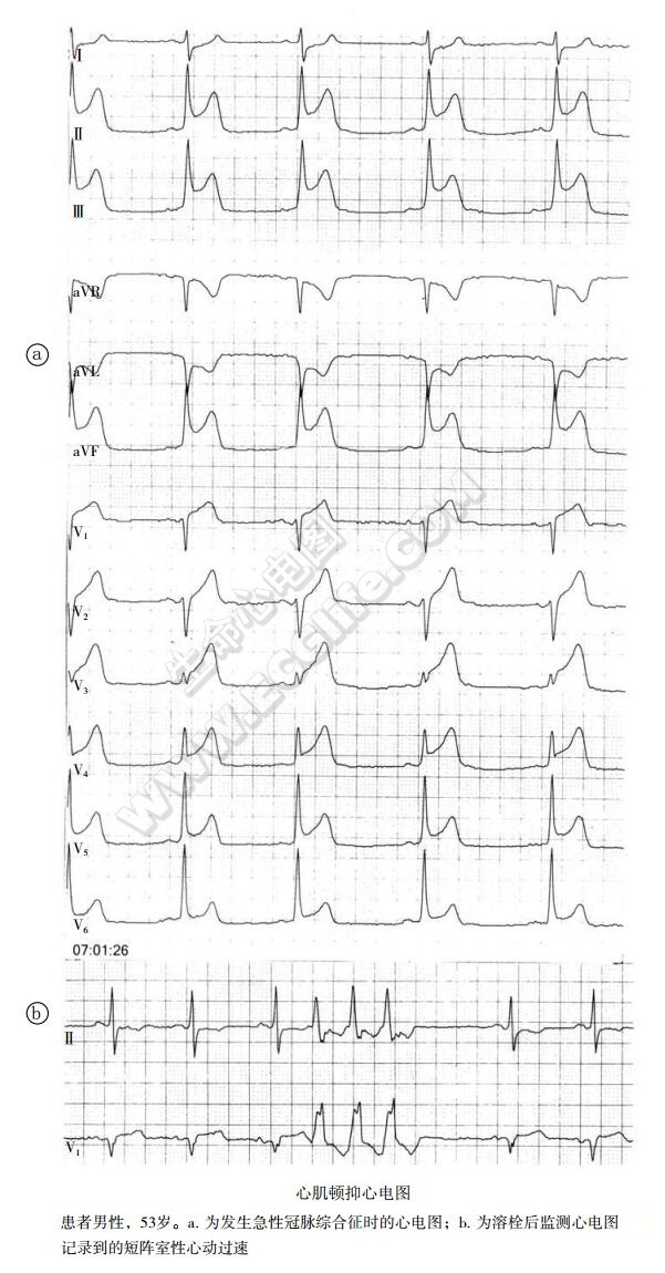 心肌顿抑心电图表现