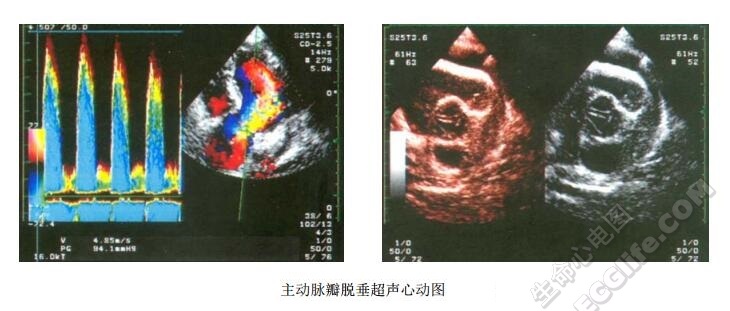 主动脉瓣脱垂综合征