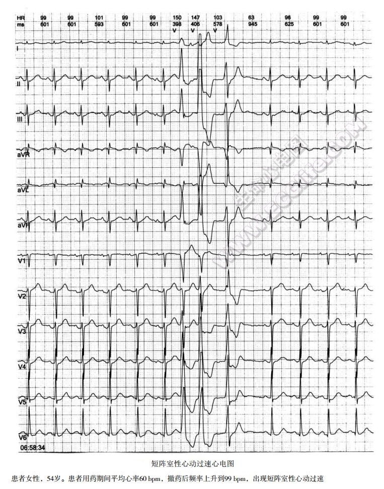 短阵室性心动过速心电图
