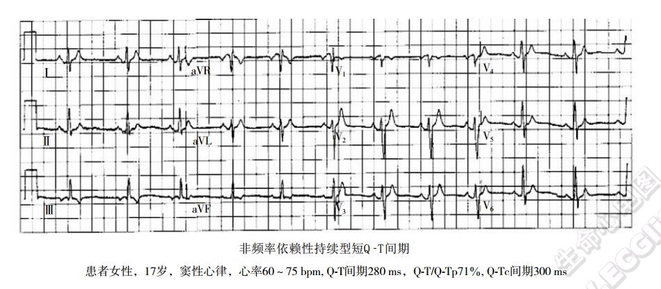 非频率依赖性持续型短QT间期