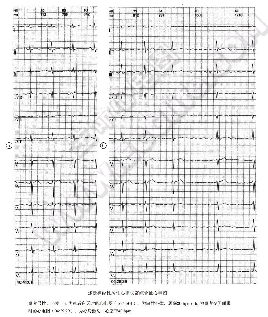 迷走神经性房性心律失常综合征心电图表现1