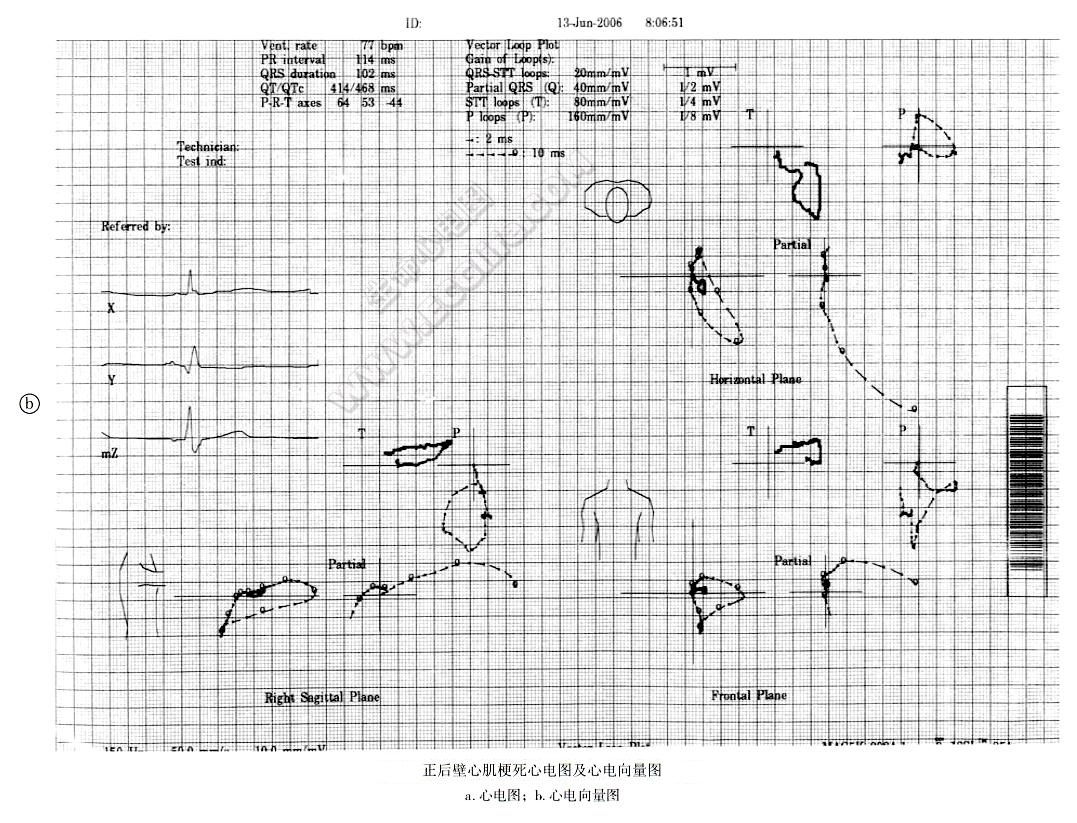 正后壁心肌梗死诊断心电向量图