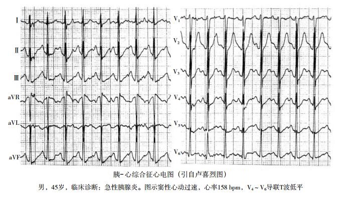 胰心综合征心电图