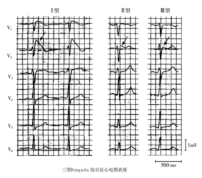 三型Brugada综合征心电图表现