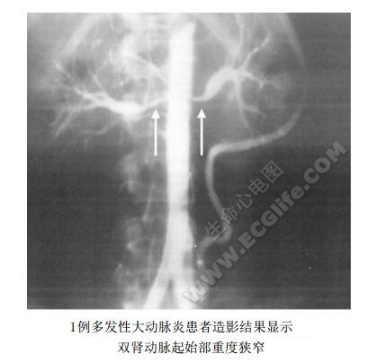 1例多发性大动脉炎患者造影结果显示双肾动脉起始部重度狭窄