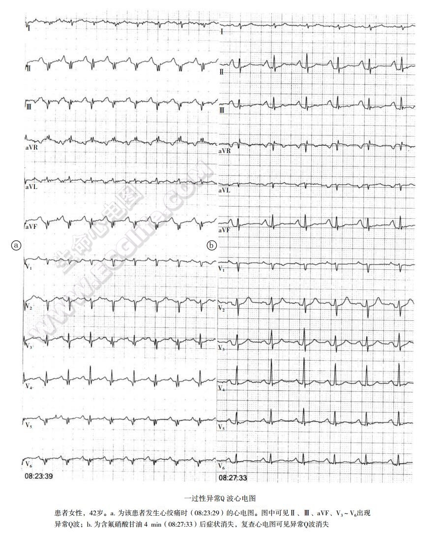 一过性异常Q波心电图