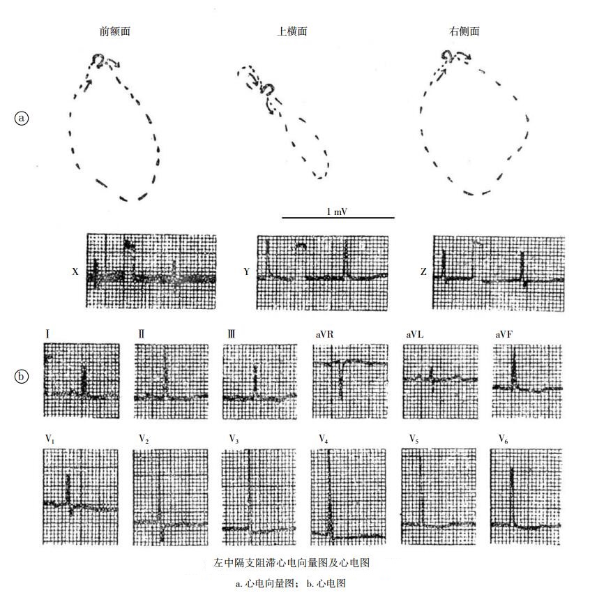 左中隔支阻滞心电向量图及心电图