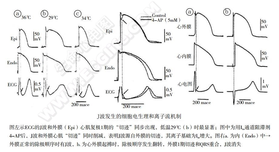 J波发生的细胞电生理和离子流机制