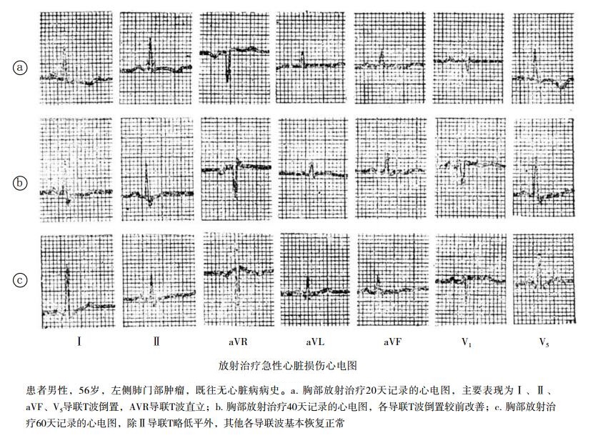 放射性心脏损伤综合征（放射诱发心脏病）