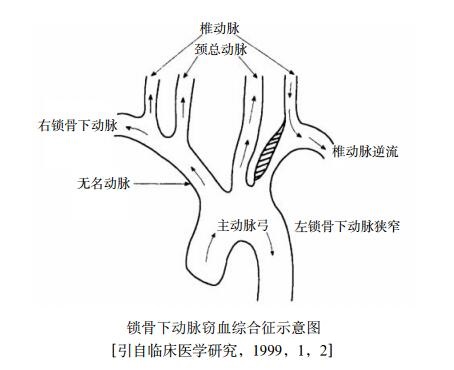 锁骨下动脉窃血综合征示意图