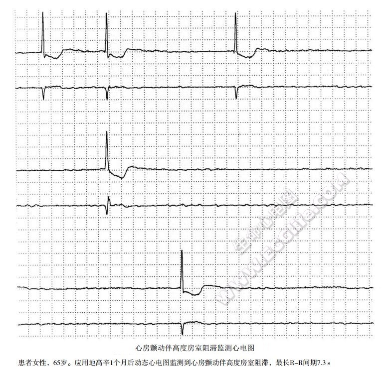 心房颤动伴高度房室阻滞监测心电图