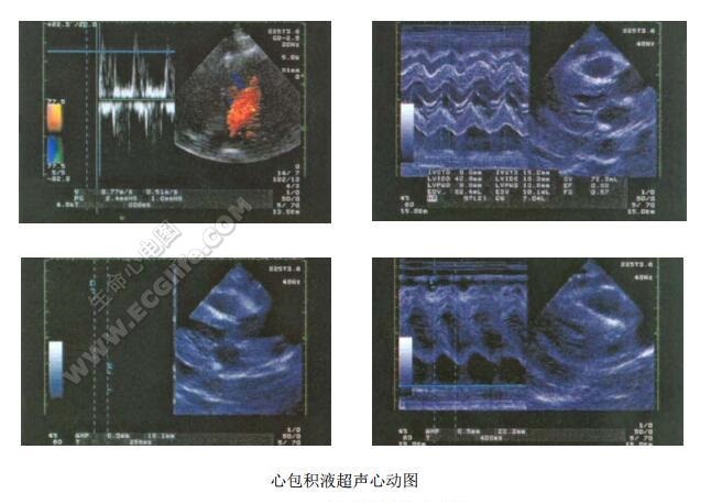 Dressler综合征心包积液超声心动图