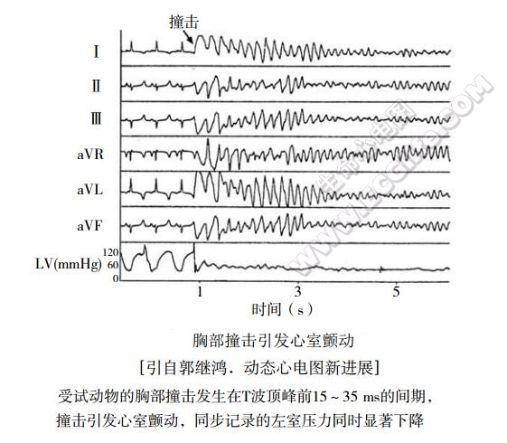 胸部撞击引发心脏心室颤动的心电图表现