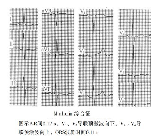 Mahaim型预激综合征（PR间期宽QRS波综合征）