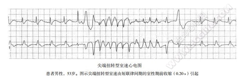 短联律间期尖端扭转型室速综合征