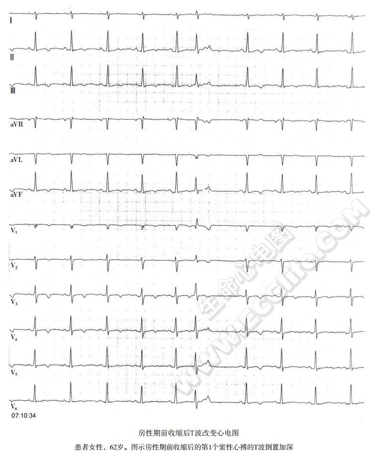 房性期前收缩后T波改变心电图表现