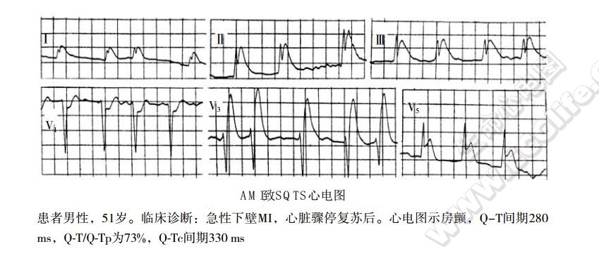 AMI致SQTS心电图