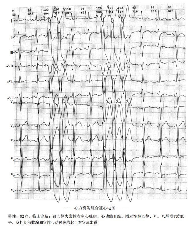 心力衰竭综合征心电图