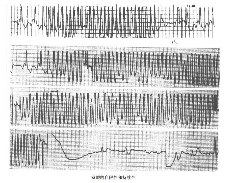 室颤的自限性和持续性心电图