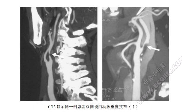 CTA显示同一例患者双侧颈内动脉重度狭窄