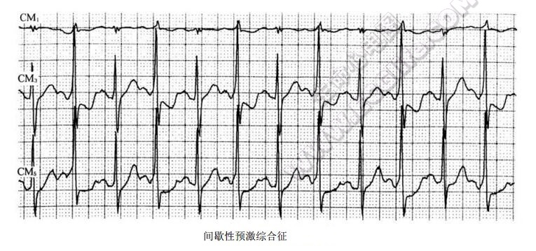 间歇性预激综合征