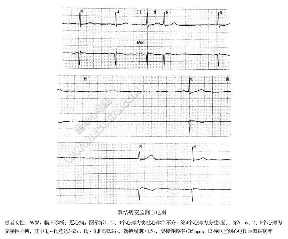 双结病变监测心电图