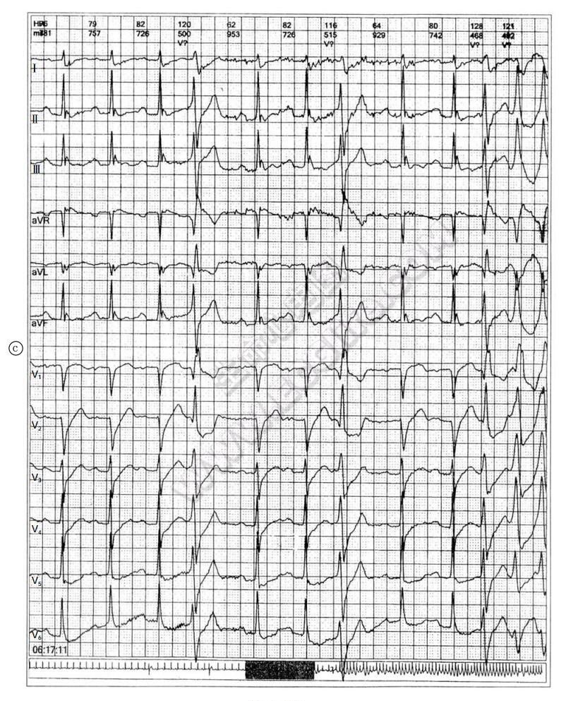 J波综合征致心脏性猝死动态心电图3