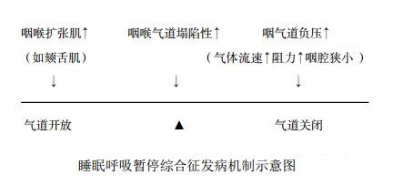 睡眠呼吸暂停综合征发病机制示意图