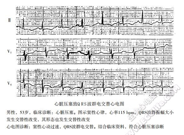 心脏压塞致QRS波群电交替心电图