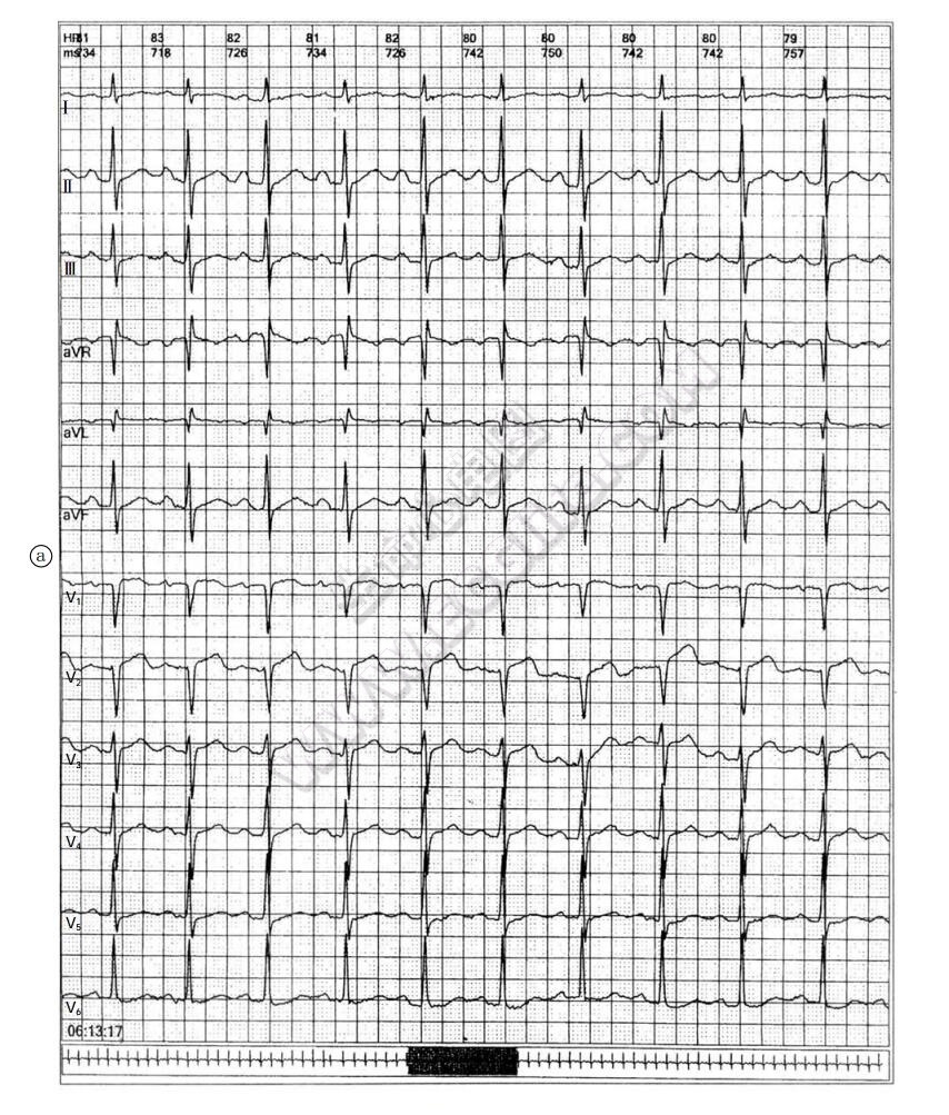 J波综合征致心脏性猝死动态心电图1